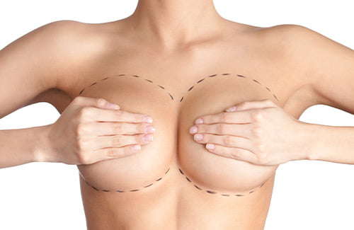 Breast Implant Removal