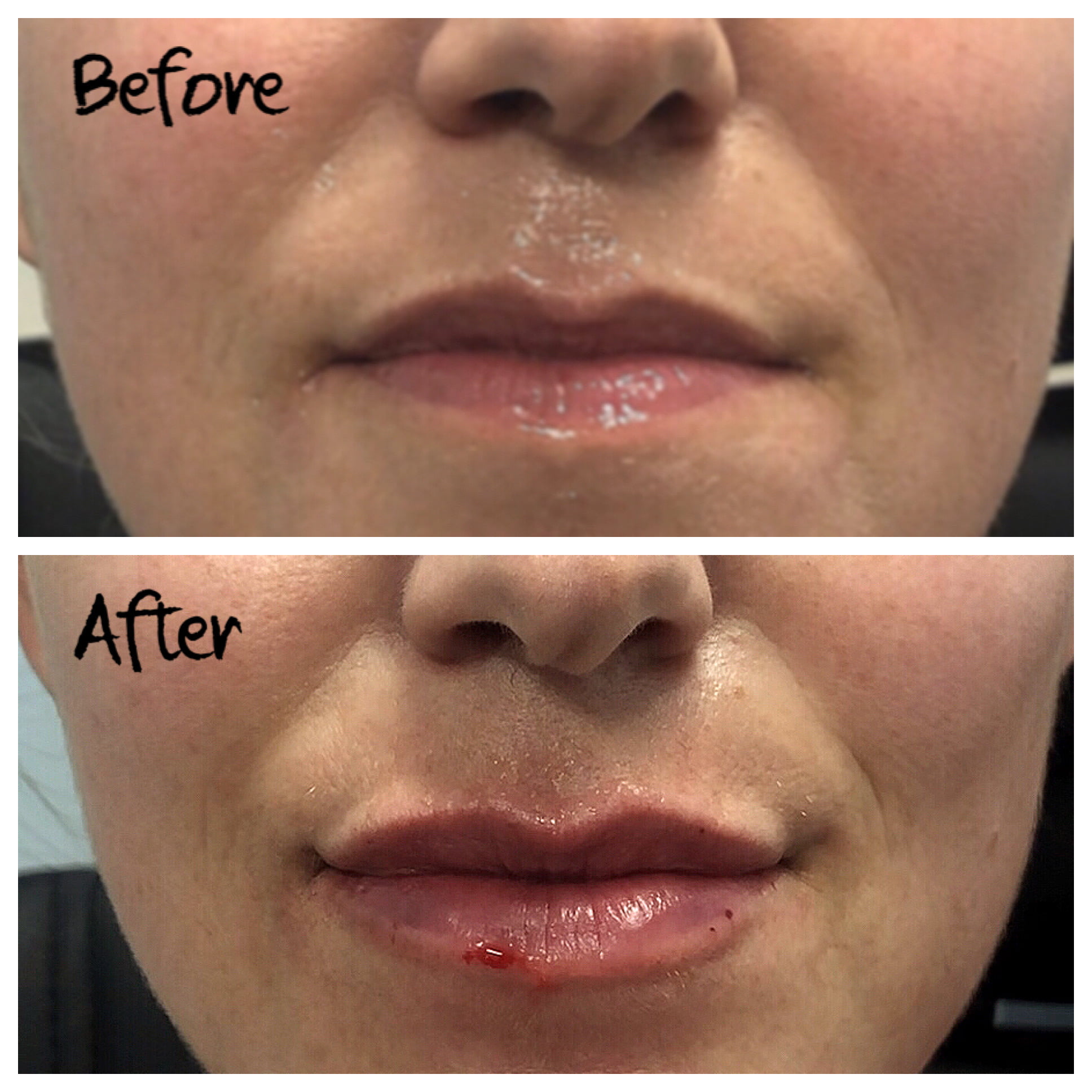 , New Kissable Filler Approved By FDA