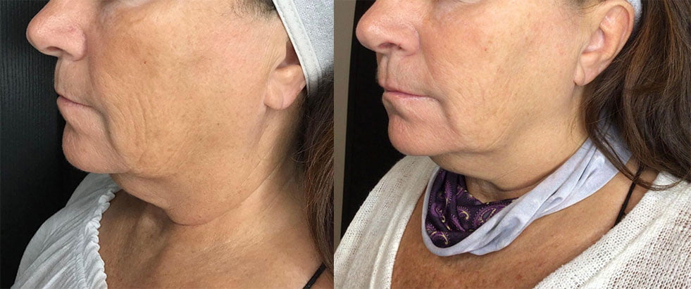 Virtue RF Microneedling from Restore SD Plastic Surgery