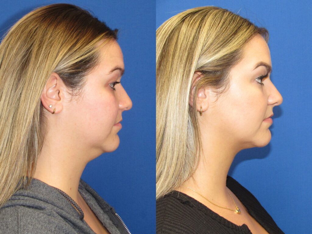 Dr. Gallus Neck Treatments