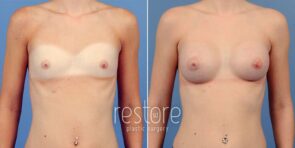 breast-augmentation-22875a-gallus