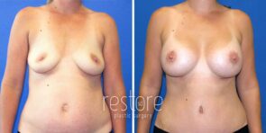 breast-augmentation-mmo-23347-a-gallus