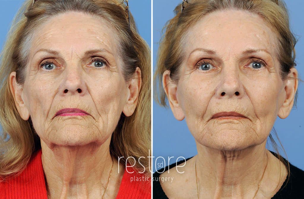 Dr. Gallus' patient's face shown after a facelift san diego and a brow lift, with smoother skin around the mouth, jawline, neck, and brow. A Facelift San Diego typically includes neck and lower face rejuvenation, while a brow lift focuses on the forehead area.