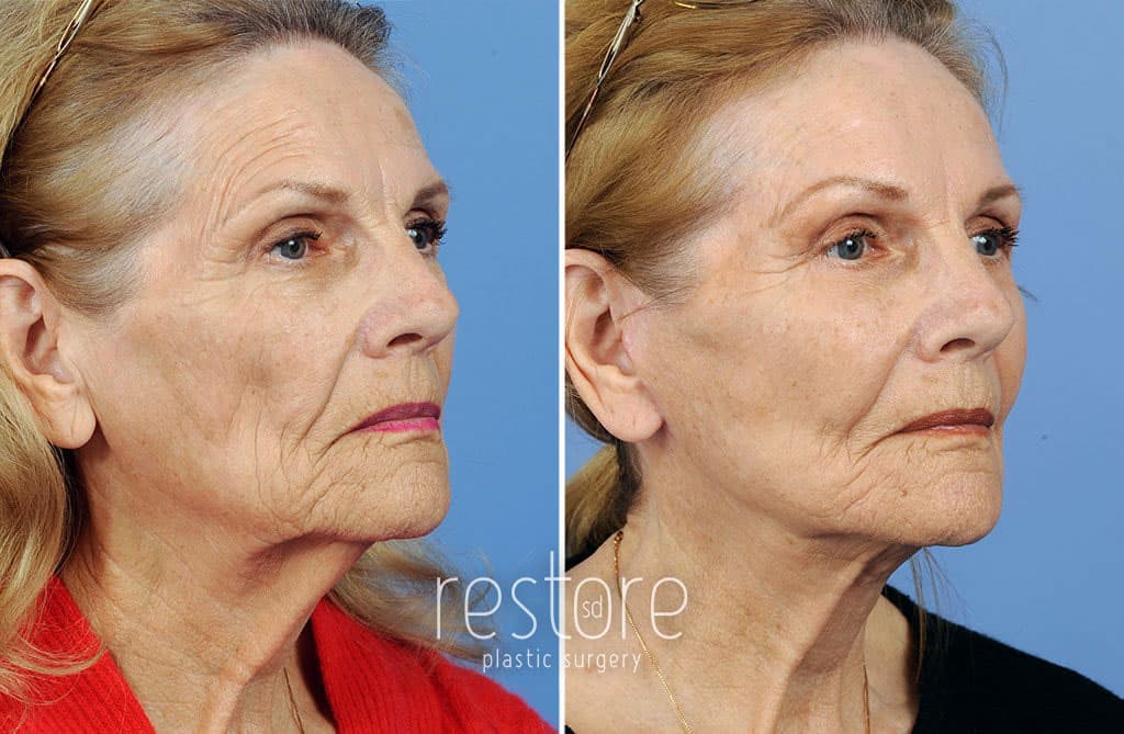 In this image, a woman is shown from the side after a facelift san diego and brow lift (forehead lift). This Facelift San Diego lifted her fallen cheeks, smoothed wrinkles, and overall created a younger appearance. The brow lift created a smoother forehead and address deep wrinkles in the area.