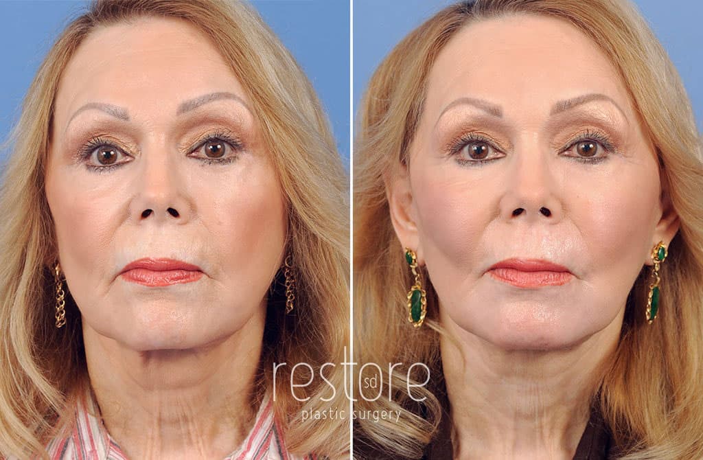 Actual patient of Dr. Katerina Gallus. Patient is shown before and after a facelift and neck lift with fat grafting to restore volume lost with age and create a more youthful appearance