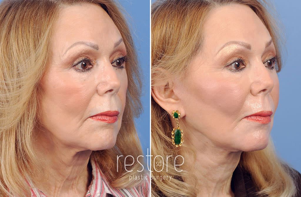 The same San Diego fat grafting patient is shown from the side, with her cheeks showing a more defined contour from fat transfer to the cheeks. She also has a firmer jawline and tightened skin in the neck.