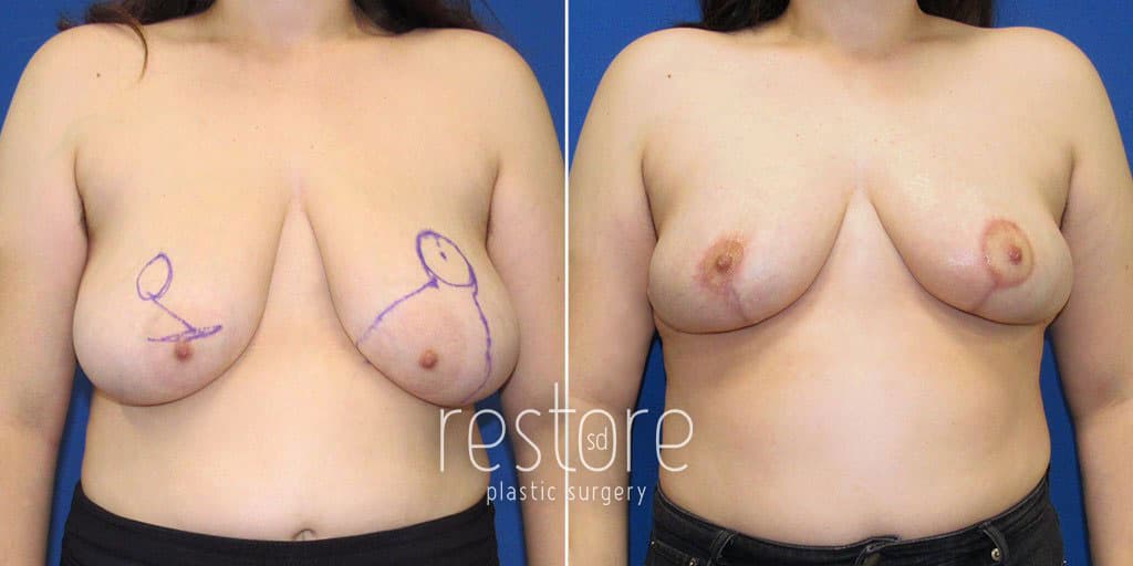 breast-reduction-23643a-gallus