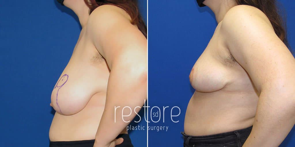 breast-reduction-23643c-gallus