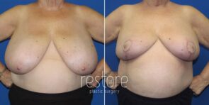 breast-reduction-23816a-gallus