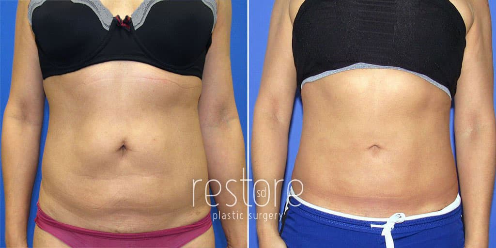 Laser Lipo 360 for Slim, Toned Abs & Love Handles Before & After