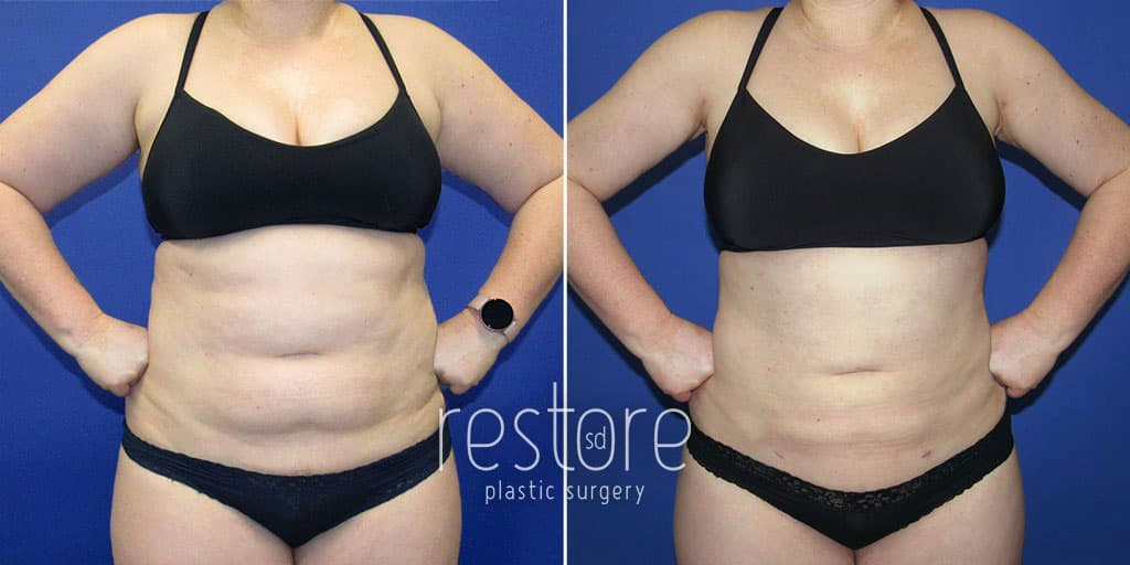 San Diego liposuction patient's abdomen before and after surgery to reduce fat pockets and slim the abdominal contour