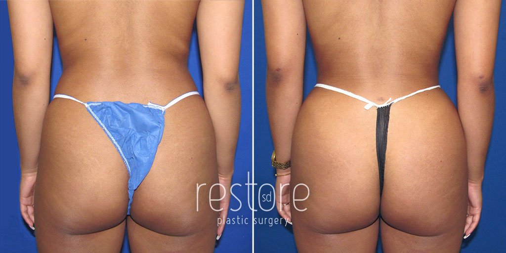 butt lift augmentation (or brazilian butt lift) before and after photos