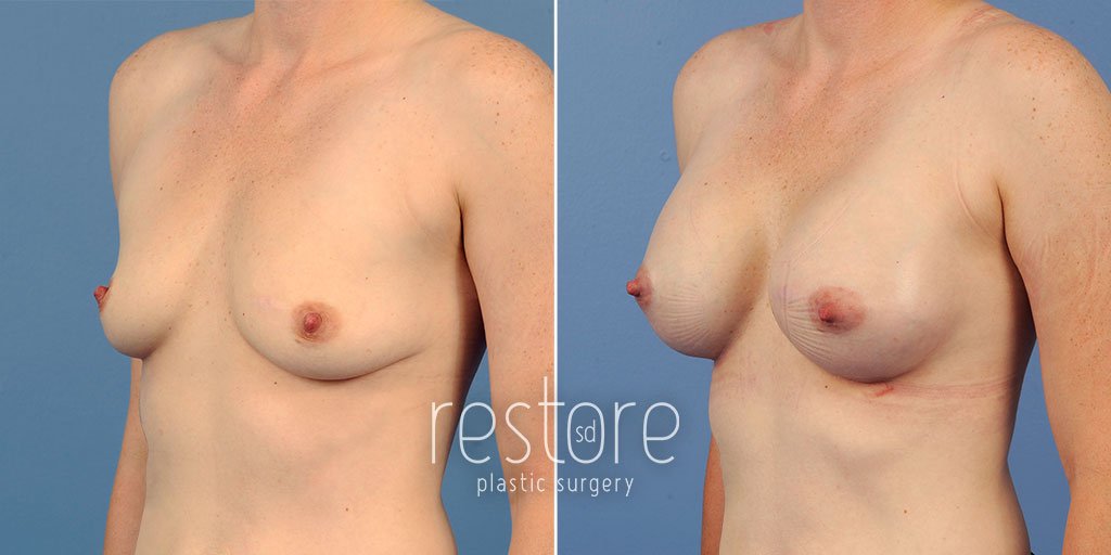 breast-augmentation-22896b-gallus