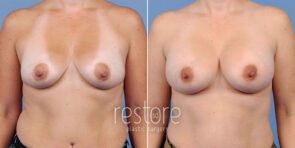 breast-augmentation-22906a-gallus
