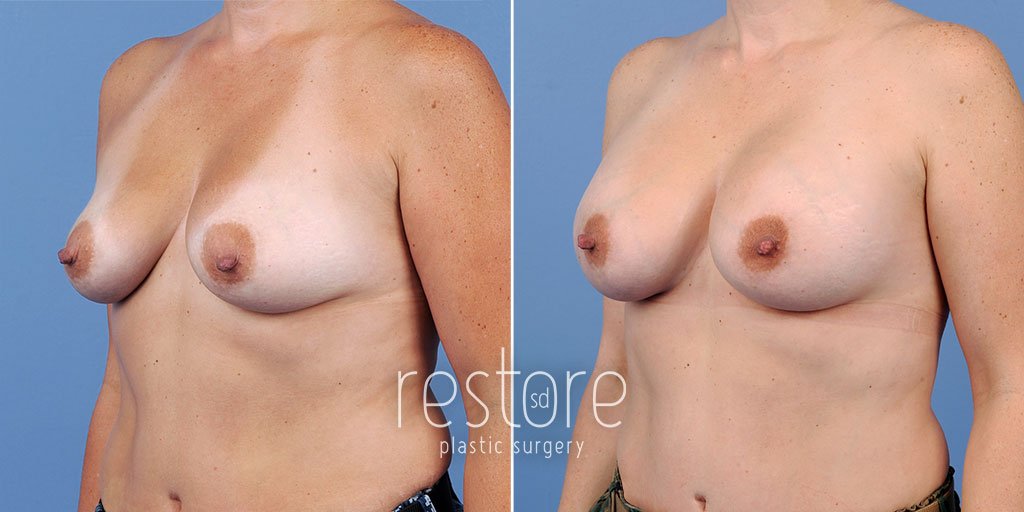 breast-augmentation-22906b-gallus