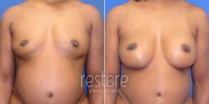 breast-augmentation-23705a-gallus