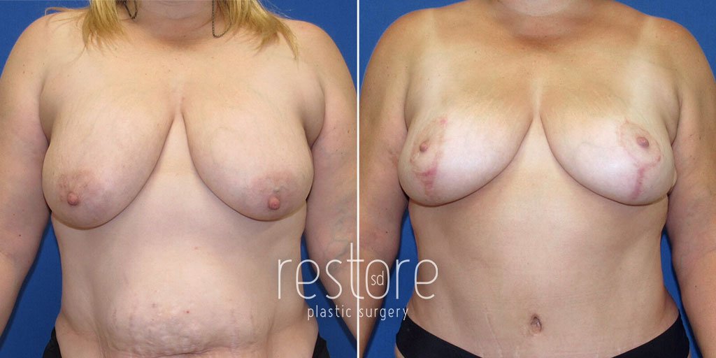 Breast Reduction with Lift