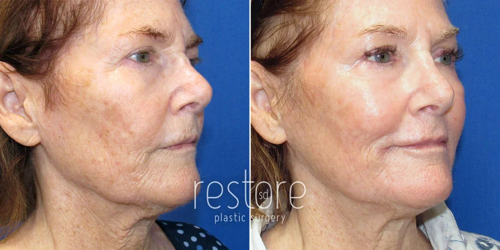 Fractionated CO2 Laser San Diego - Restore SD Plastic Surgery