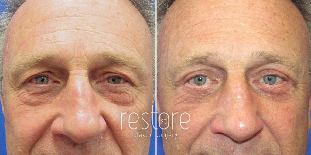 San Diego eyelid surgery for men