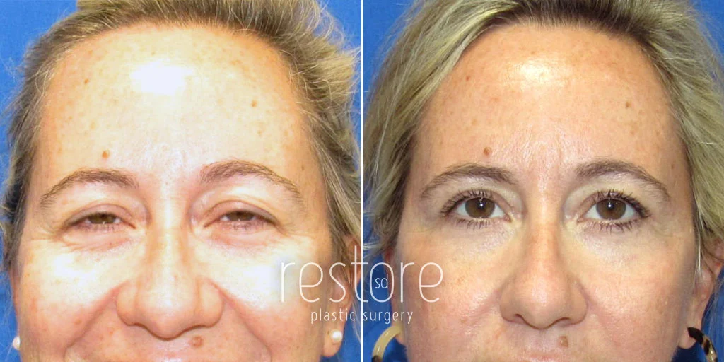 Eyelid Lift patient before and after surgery to raise hooded eyelids and improve field of vision