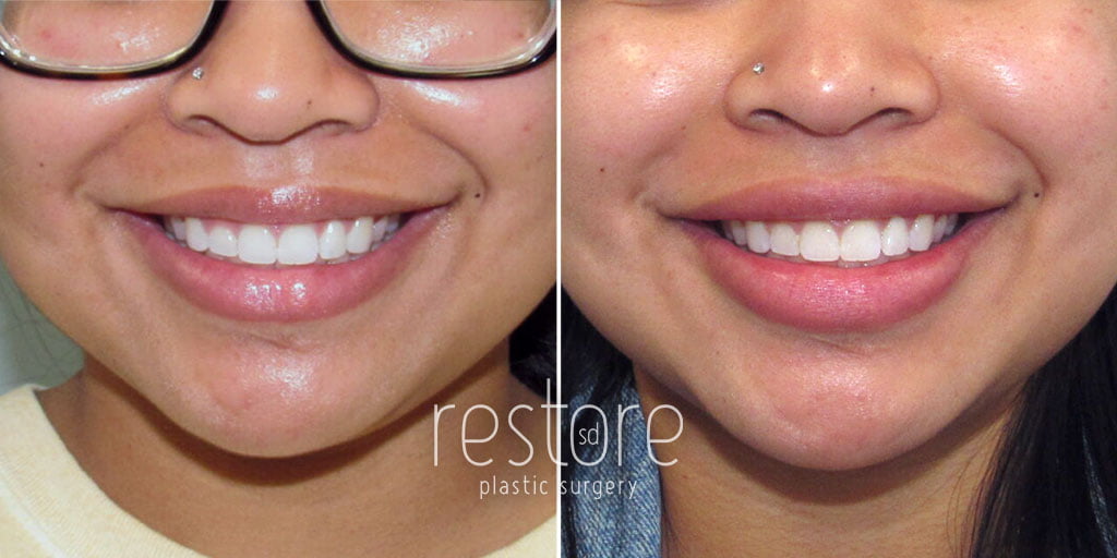 San Diego lip filler patient shown before and after lip augmentation treatment at our La Jolla office