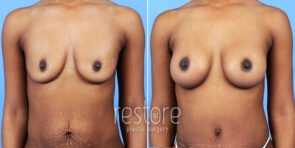 mmo-breast-augmentation-23062a-gallus