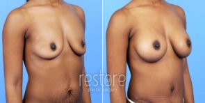 mmo-breast-augmentation-23062b-gallus