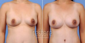mmo-breast-augmentation-23108a-gallus