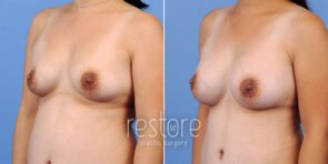 mmo-breast-augmentation-23108b-gallus