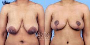 mmo-breast-reduction-23089a-gallus