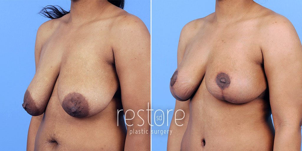 mmo-breast-reduction-23089b-gallus