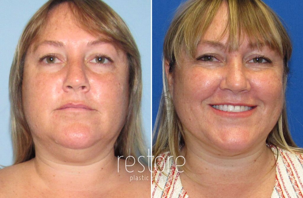 Woman's face shown before and after liposuction with Renuvion skin tightening in the neck and jowls to slim and define the jawline