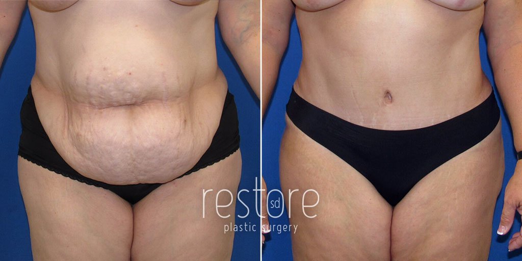 Photo of patient before and after tummy tuck