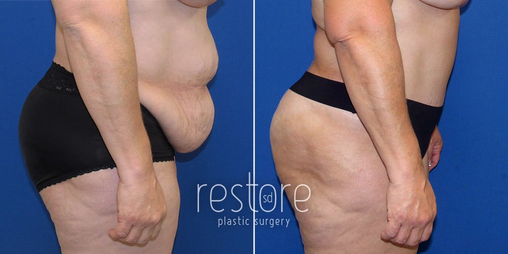 Photo of patient before and after tummy tuck