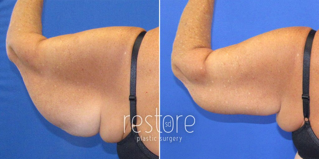 ARM LIFT GALLERY - Heavenly Plastic Surgery