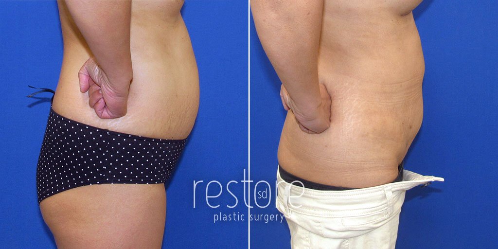 Cellulite Causes & Treatments  Restore SD Plastic Surgery in San