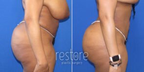 brazilian-butt-lift-liposuction-22499c-gallus