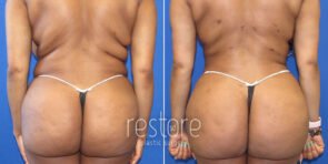 brazilian-butt-lift-liposuction-22499d-gallus