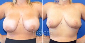 breast-reduction-22393a-gallus
