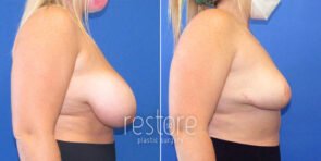 breast-reduction-22393c-gallus
