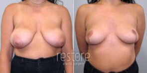 breast-reduction-22417a-gallus