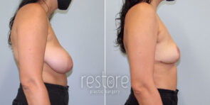 breast-reduction-22417c-gallus