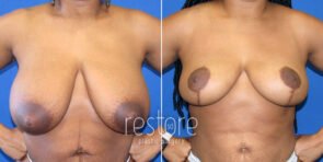 breast-reduction-22499a-gallus