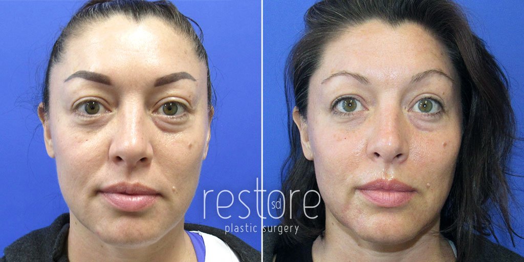 This San Diego Botox and filler patient is shown before and after an injectable liquid facelift with Botox and Juvederm to help her appear more refreshed and rested with smooth under-eye troughs, a Botox lip flip, and more