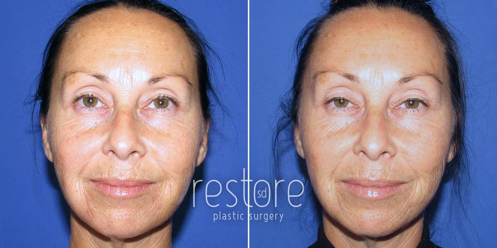 Our La Jolla Botox patient received Botox in the upper face and upper lip to smooth forehead lines, frown lies, crow's feet, and upper lip lines or lipstick lines