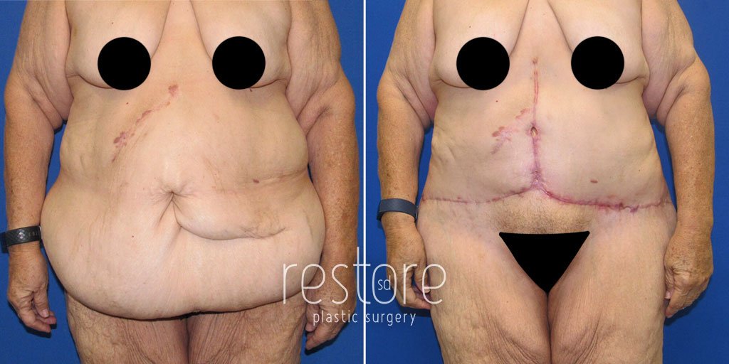 tummy-tuck-extended-22315a-gallus