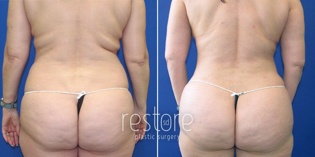 Patient is shown from behind after liposuction to reduce fat deposits in the flanks, also known as love handles, leading to a more hourglass figure
