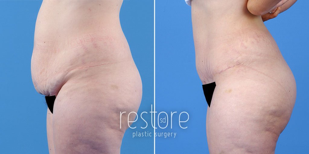 Tummy tuck before and after photo