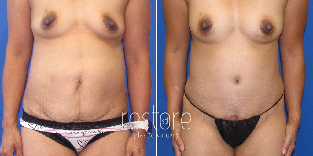 tummy-tuck-liposuction-23282a-gallus