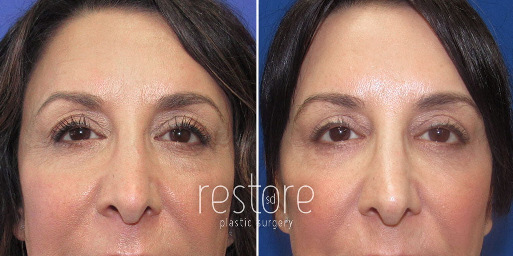 Eyelid lift patient shown before and after upper blepharoplasty surgery